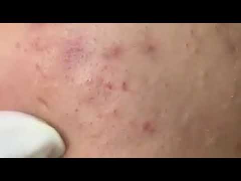 Blackheads & Milia, Big Cystic Acne Blackheads Extraction Whiteheads Removal Pimple Popping EP00#N1