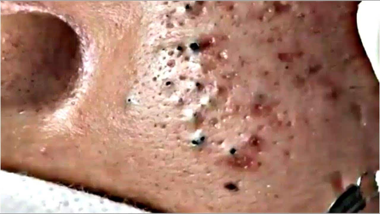 Blackheads & Milia, Big Cystic Acne Blackheads Extraction Whiteheads Removal Pimple Popping EP00 #Z4
