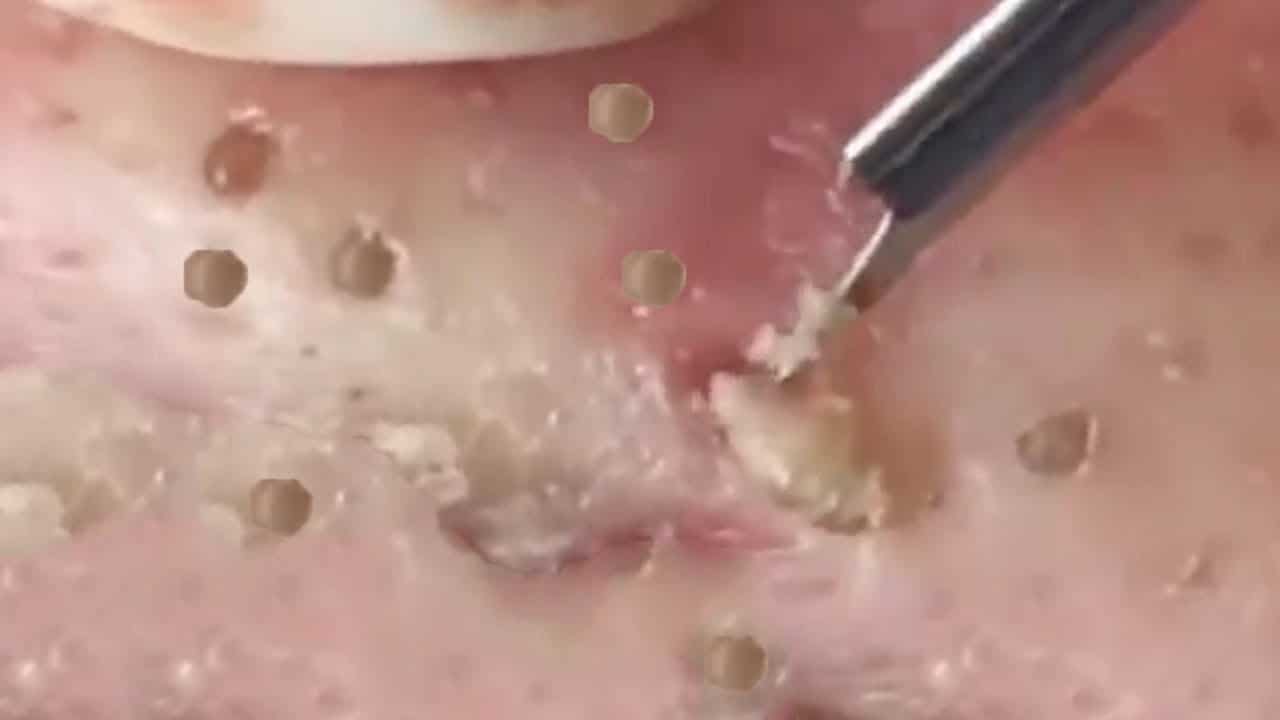Blackheads & Milia, Big Cystic Acne Blackheads Extraction Whiteheads Removal Pimple Popping EP00#N2