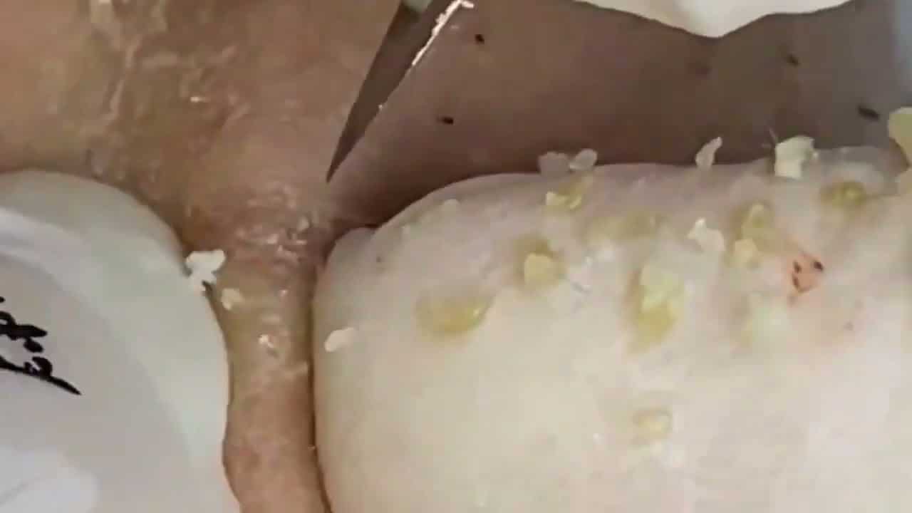 Blackheads & Milia, Big Cystic Acne Blackheads Extraction Whiteheads Removal Pimple Popping Part13