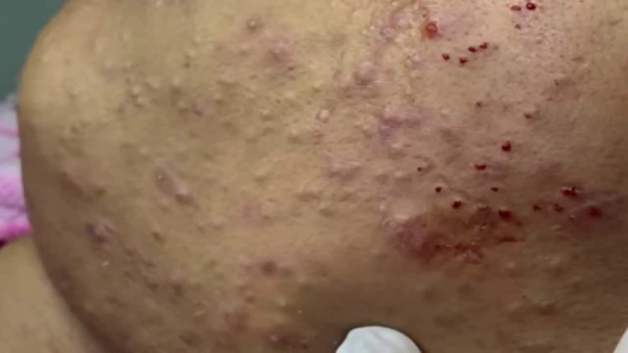 Blackheads & Milia, Big Cystic Acne Blackheads Extraction Whiteheads Removal Pimple Popping EP00#25