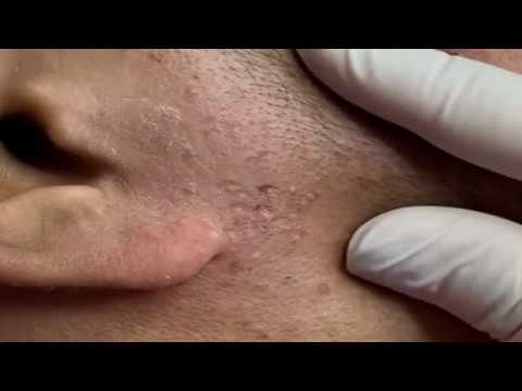 Blackheads & Milia, Big Cystic Acne Blackheads Extraction Whiteheads Removal Pimple Popping EP00#23
