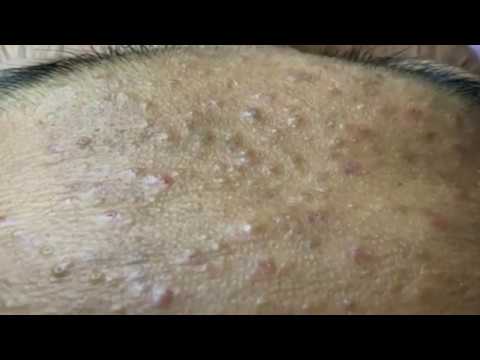 Blackheads & Milia, Big Cystic Acne Blackheads Extraction Whiteheads Removal Pimple Popping EP00#022