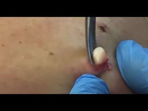 Blackheads & Milia, Big Cystic Acne Blackheads Extraction Whiteheads Removal Pimple Popping EP00#21