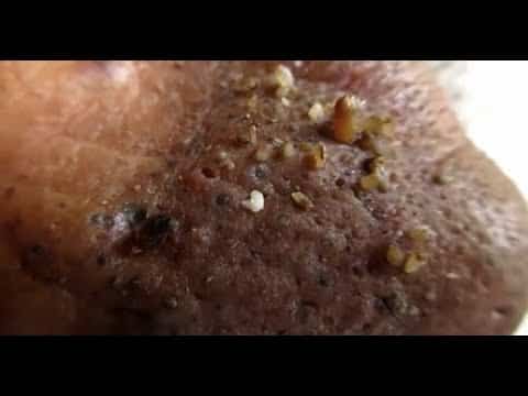Blackheads & Milia, Big Cystic Acne Blackheads Extraction Whiteheads Removal Pimple Popping EP00#19