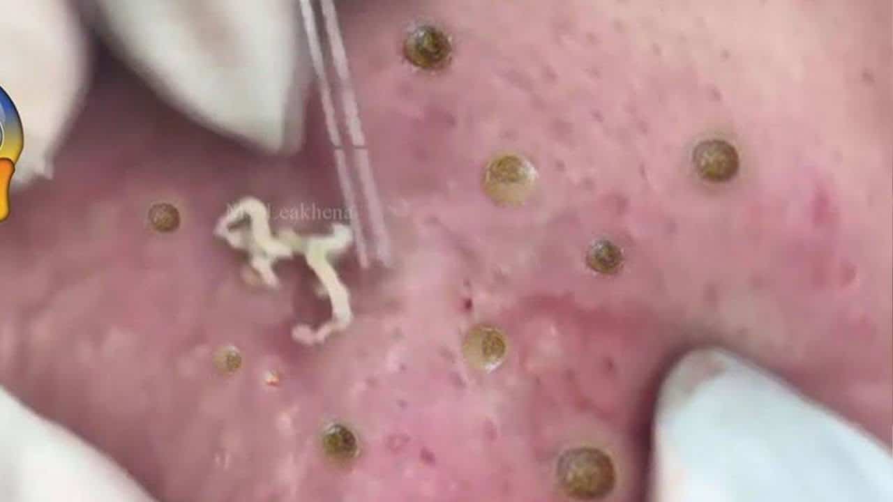 Blackheads & Milia, Big Cystic Acne Blackheads Extraction Whiteheads Removal Pimple Popping EP00#17