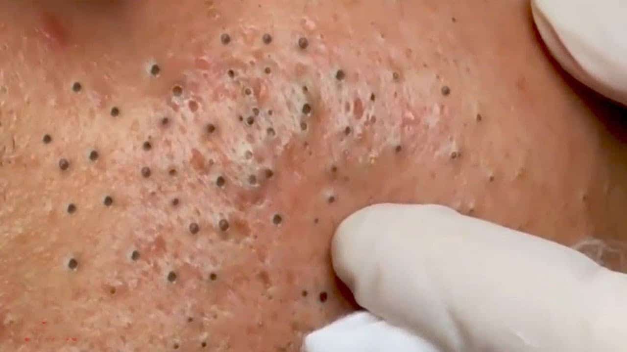 Blackheads & Milia, Big Cystic Acne Blackheads Extraction Whiteheads Removal Pimple Popping EP00#16