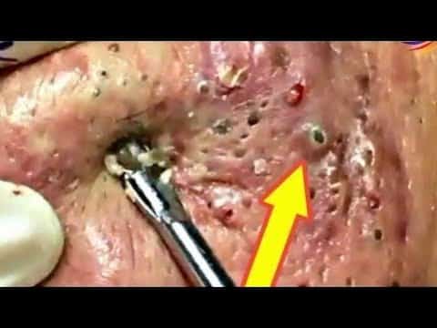 Blackheads & Milia, Big Cystic Acne Blackheads Extraction Whiteheads Removal Pimple Popping Part 58