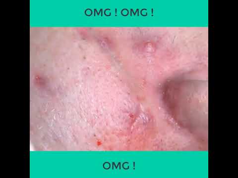 Blackheads & Milia, Big Cystic Acne Blackheads Extraction Whiteheads Removal Pimple Popping-#011