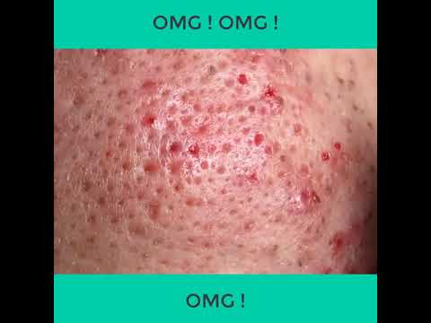 Blackheads & Milia, Big Cystic Acne Blackheads Extraction Whiteheads Removal Pimple Popping-#004