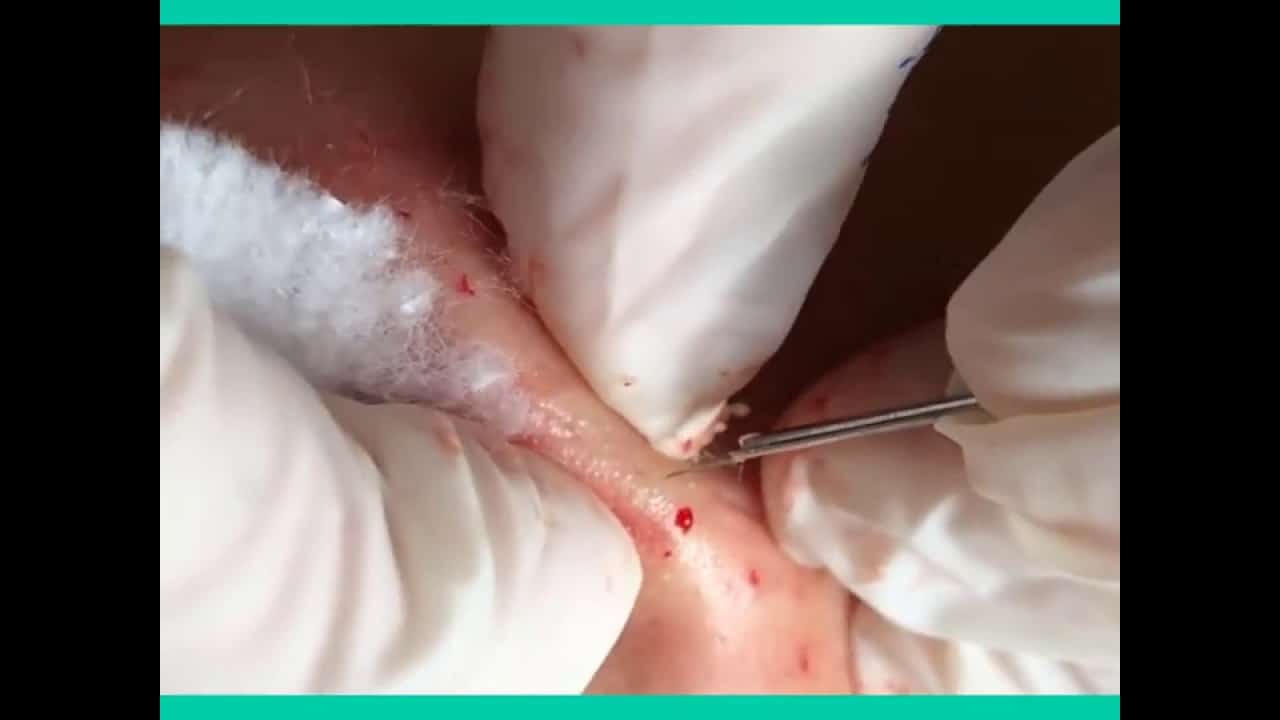 Blackheads & Milia, Big Cystic Acne Blackheads Extraction Whiteheads Removal Pimple Popping-#001
