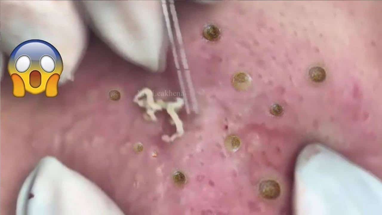 Blackheads & Milia, Big Cystic Acne Blackheads Extraction Whiteheads Removal Pimple Popping