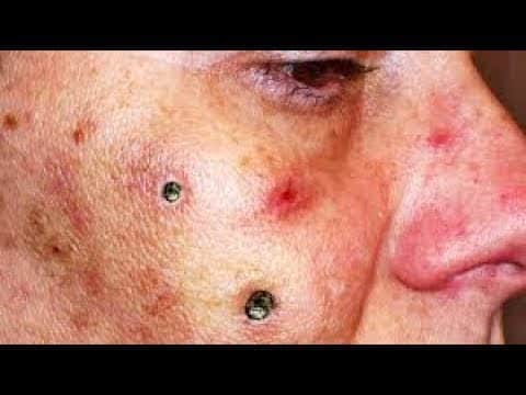Blackheads & Milia, Big Cystic Acne Blackheads Extraction Whiteheads Removal Pimple Popping :7