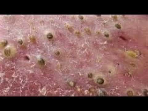 Blackheads & Milia, Big Cystic Acne Blackheads Extraction Whiteheads Removal Pimple Popping Part 41