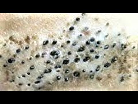 Blackheads & Milia, Big Cystic Acne Blackheads Extraction Whiteheads Removal Pimple Popping Part 37