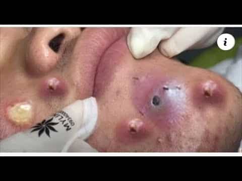 Blackheads & Milia, Big Cystic Acne Blackheads Extraction Whiteheads Removal Pimple Popping Part 35