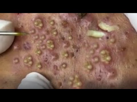 Blackheads & Milia, Big Cystic Acne Blackheads Extraction Whiteheads Removal Pimple Popping