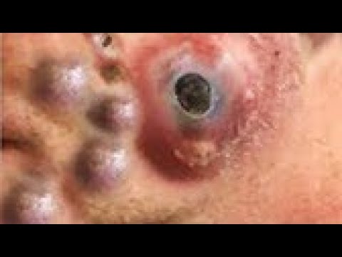 Blackheads & Milia, Big Cystic Acne Blackheads Extraction Whiteheads Removal Pimple Popping Part 33