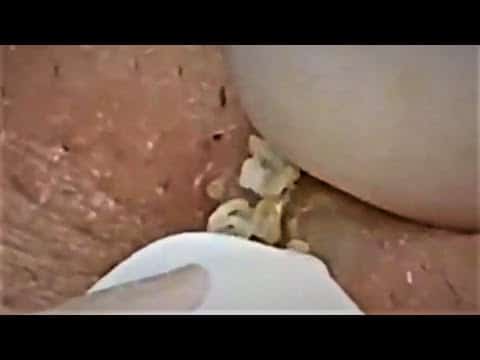 Blackheads & Milia, Big Cystic Acne Blackheads Extraction Whiteheads Removal Pimple Popping Part 24