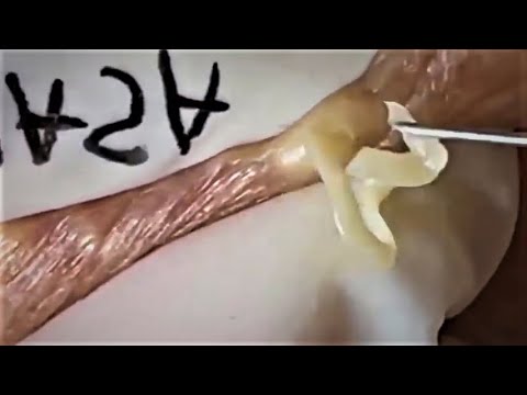 Blackheads & Milia, Big Cystic Acne Blackheads Extraction Whiteheads Removal Pimple Popping Part 23