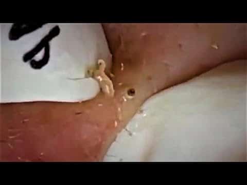 Blackheads & Milia, Big Cystic Acne Blackheads Extraction Whiteheads Removal Pimple Popping Part 22