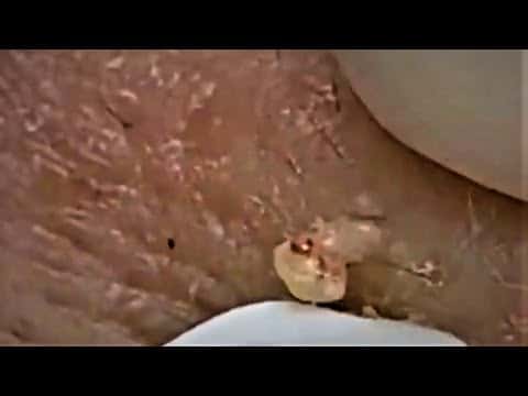 Blackheads & Milia, Big Cystic Acne Blackheads Extraction Whiteheads Removal Pimple Popping Part 21