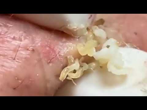 Blackheads & Milia, Big Cystic Acne Blackheads Extraction Whiteheads Removal Pimple Popping Part 19