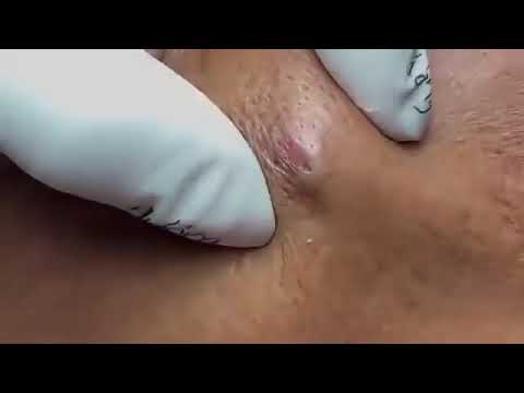 Blackheads ,Milia, Big Cystic Acne Blackheads Extraction Whiteheads Removal Pimple Popping #1