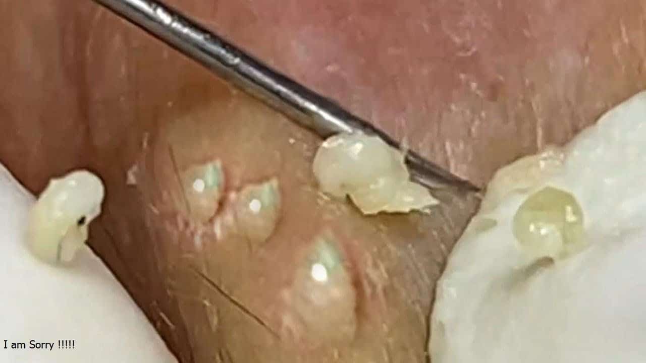 Blackheads & Milia, Big Cystic Acne Blackheads Extraction Whiteheads Removal Pimple Popping #511
