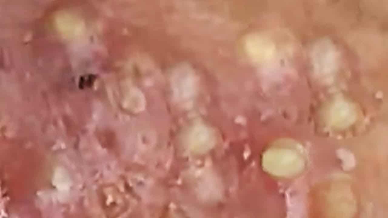 Blackheads  Milia Big Cystic Acne Blackheads Extraction Whiteheads Removal Pimple Popping#33