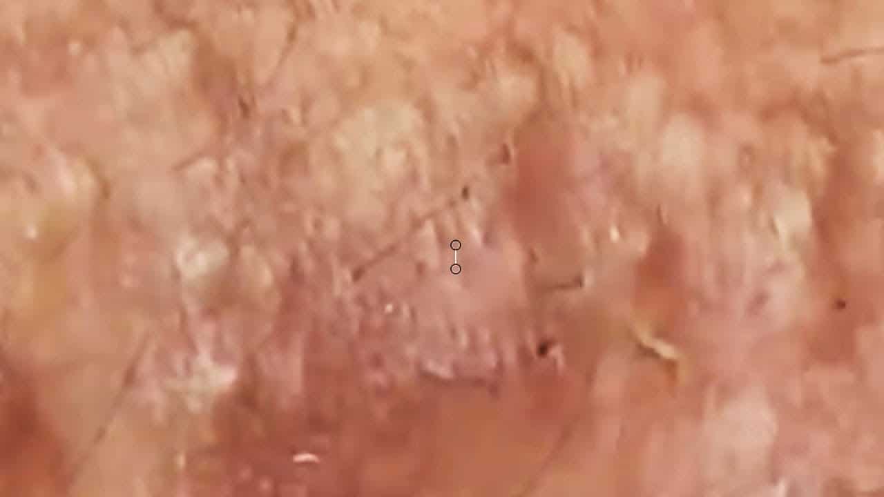 Blackheads  Milia Big Cystic Acne Blackheads Extraction Whiteheads Removal Pimple Popping#221