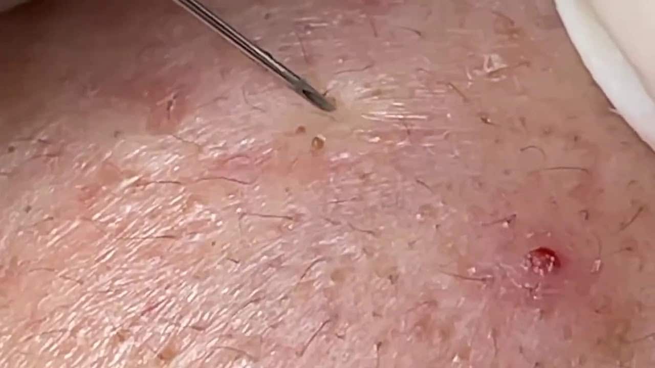 Blackheads  Milia Big Cystic Acne Blackheads Extraction Whiteheads Removal Pimple Popping#4324