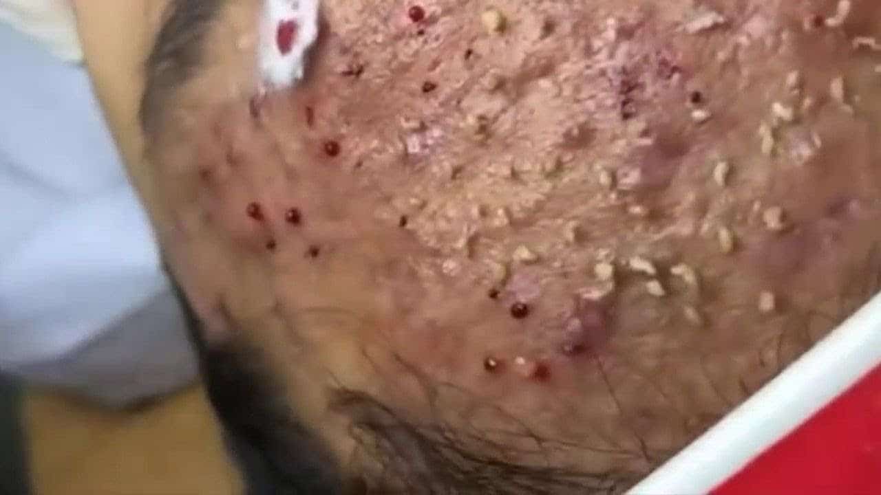 Blackheads  Milia Big Cystic Acne Blackheads Extraction Whiteheads Removal Pimple Popping#433