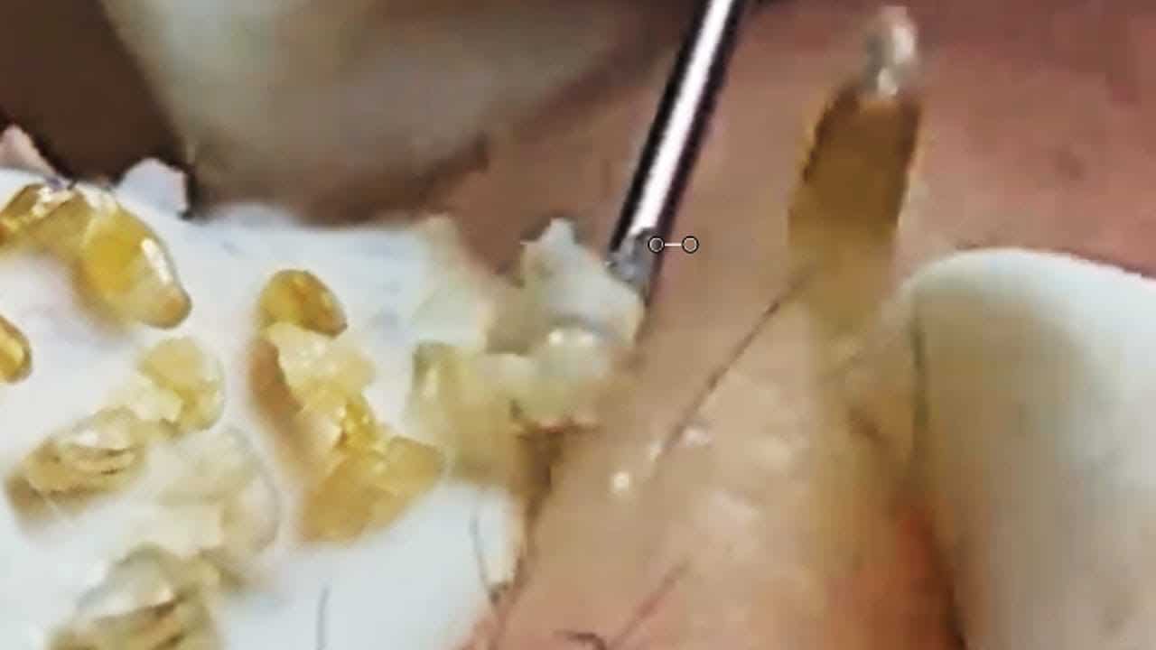 Blackheads  Milia Big Cystic Acne Blackheads Extraction Whiteheads Removal Pimple Popping#444