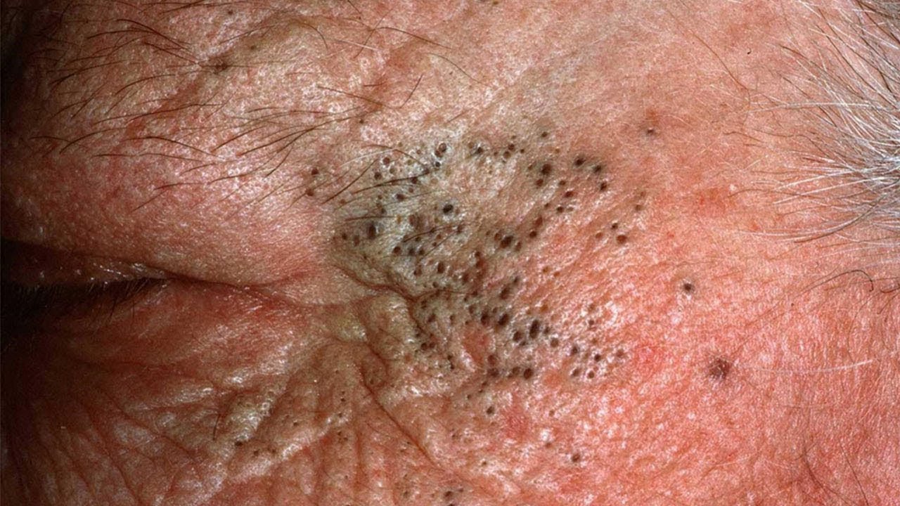 Blackheads  Milia Big Cystic Acne Blackheads Extraction Whiteheads Removal Pimple Popping#422