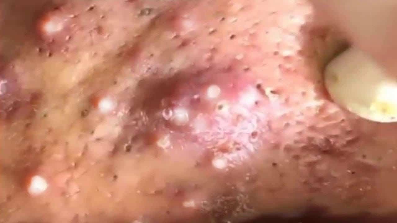 Blackheads  Milia Big Cystic Acne Blackheads Extraction Whiteheads Removal Pimple Popping #443