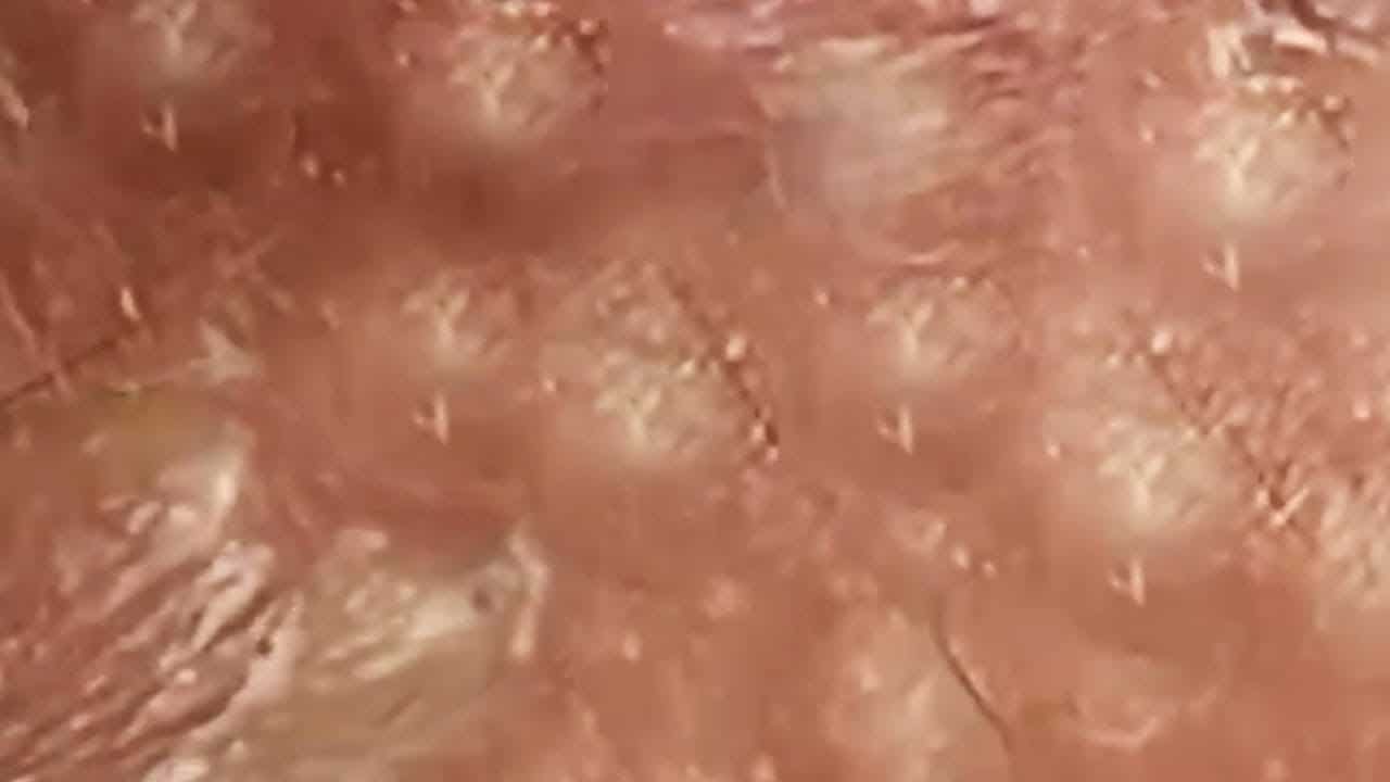 Blackheads  Milia Big Cystic Acne Blackheads Extraction Whiteheads Removal Pimple Popping #220