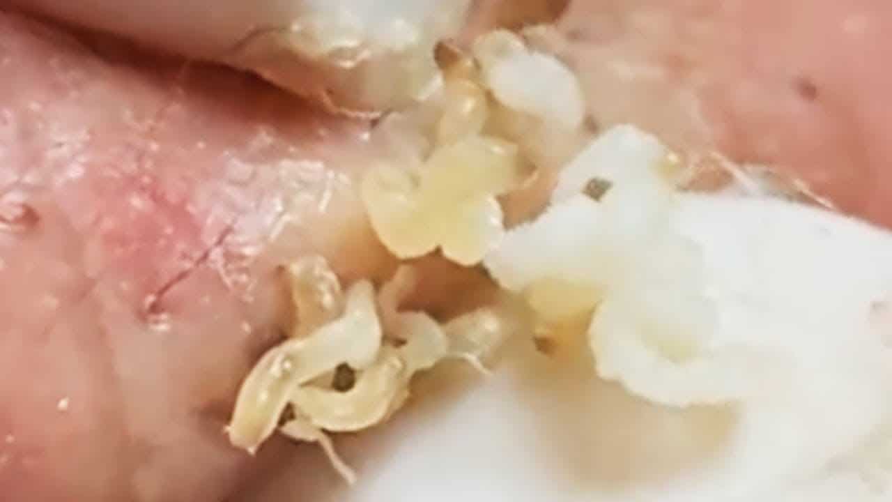 Blackheads  Milia Big Cystic Acne Blackheads Extraction Whiteheads Removal Pimple Popping #2021