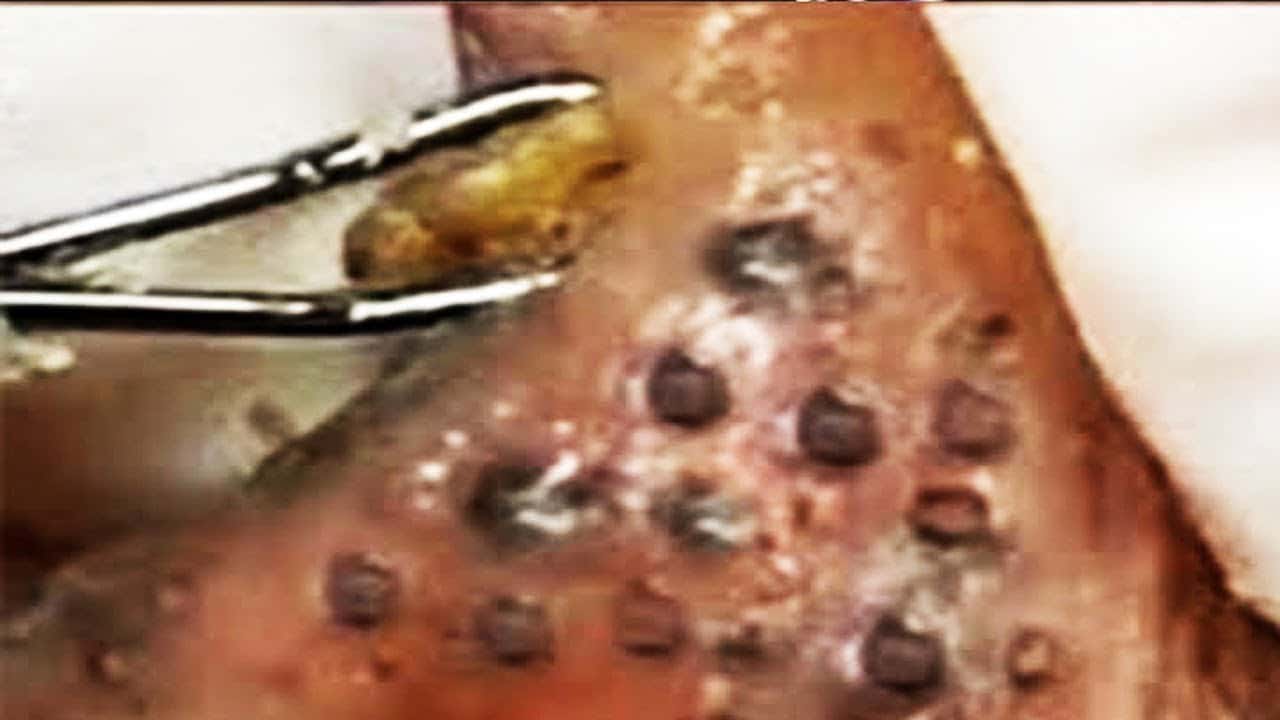 Blackheads  Milia Big Cystic Acne Blackheads Extraction Whiteheads Removal Pimple Popping 457