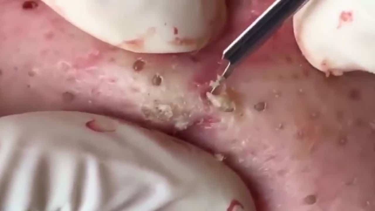 Blackheads & Milia, Big Cystic Acne Blackheads Extraction Whiteheads Removal Pimple Popping [EP13]