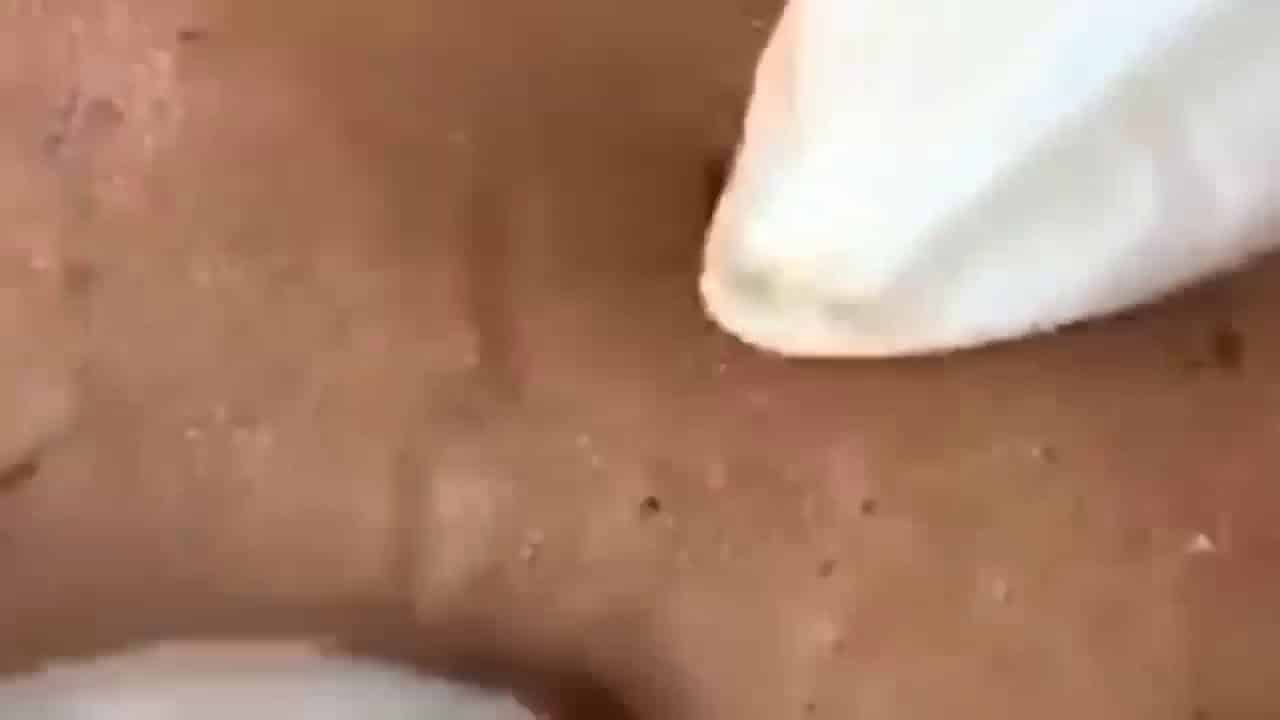 Blackheads & Milia, Big Cystic Acne Blackheads Extraction Whiteheads Removal Pimple Popping [EP6]