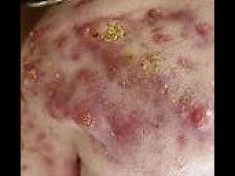 Blackheads & Milia, Big Cystic Acne Blackheads Extraction Whiteheads Removal Pimple Popping Part 221