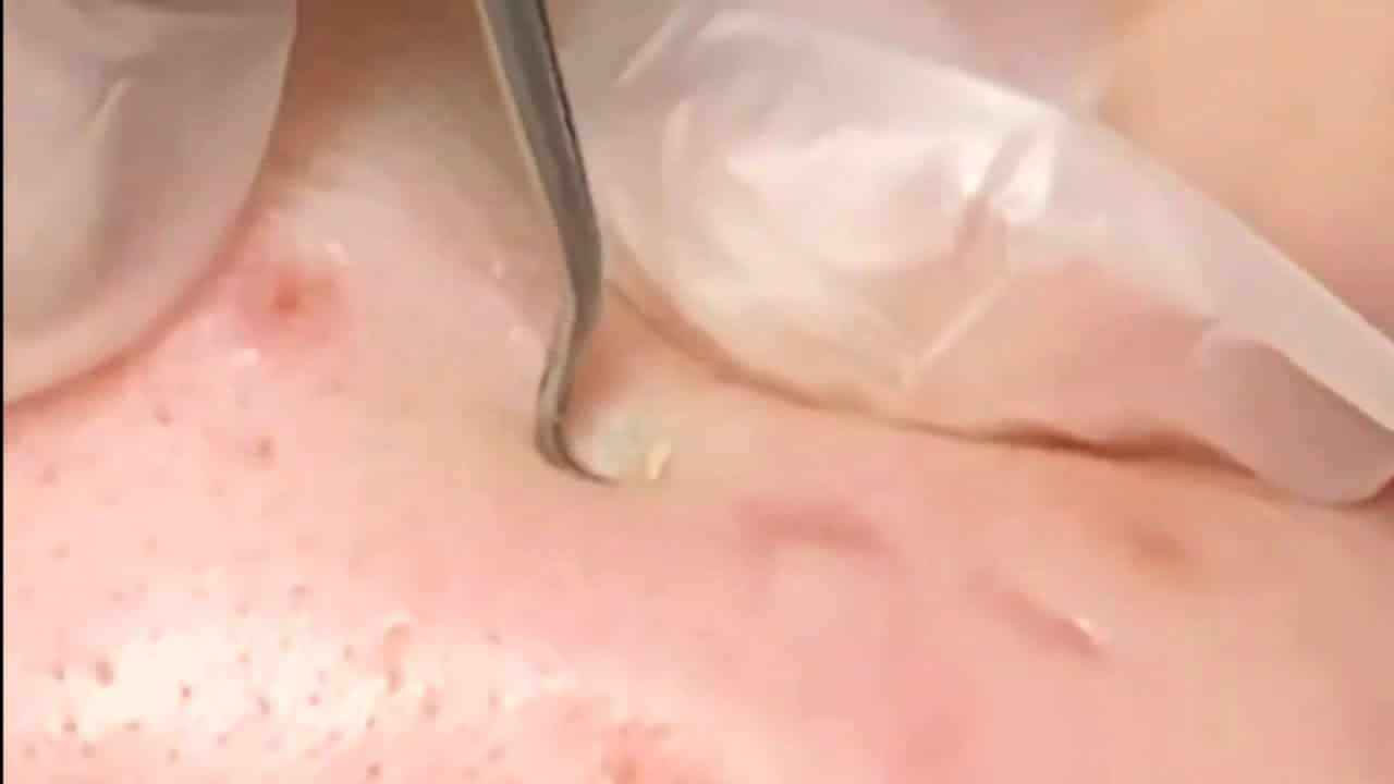 Blackheads & Milia, Big Cystic Acne Blackheads Extraction Whiteheads Removal Pimple Popping [EP5]