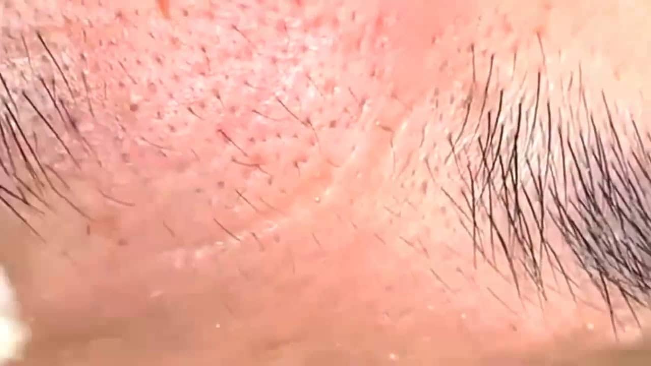 Blackheads & Milia, Big Cystic Acne Blackheads Extraction Whiteheads Removal Pimple Popping [EP4]