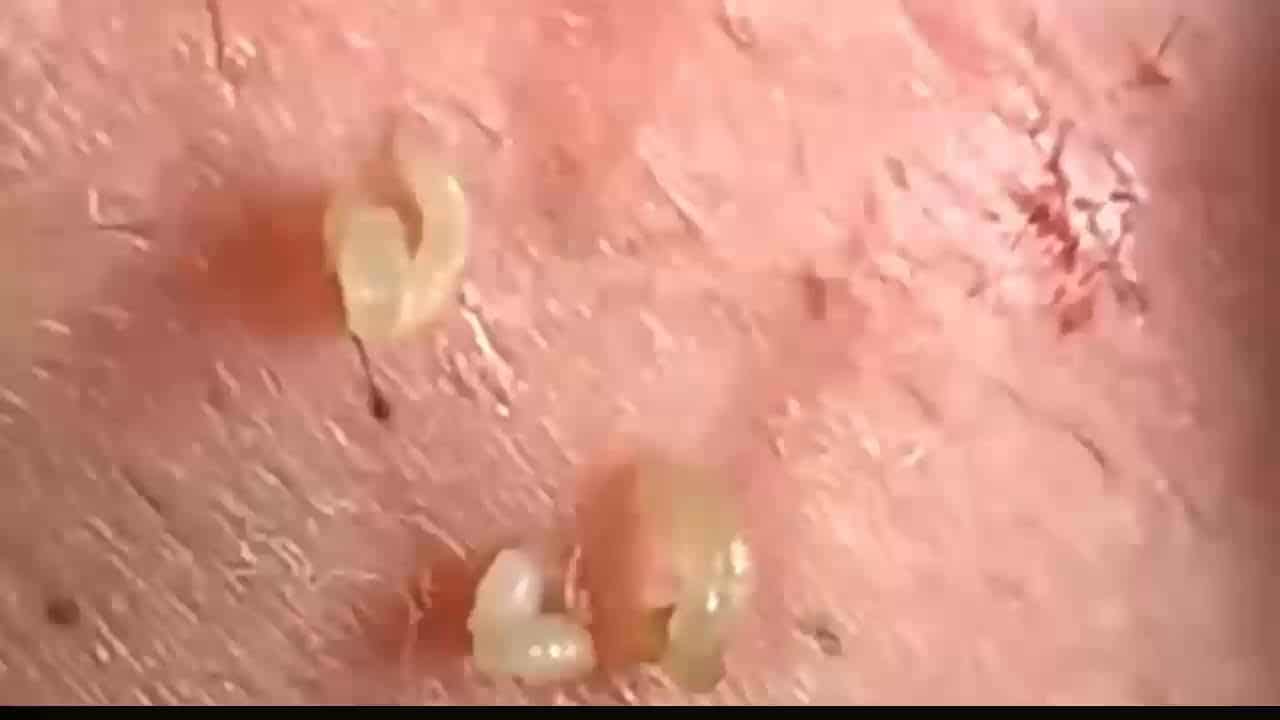 Blackheads & Milia, Big Cystic Acne Blackheads Extraction Whiteheads Removal Pimple Popping [EP3]