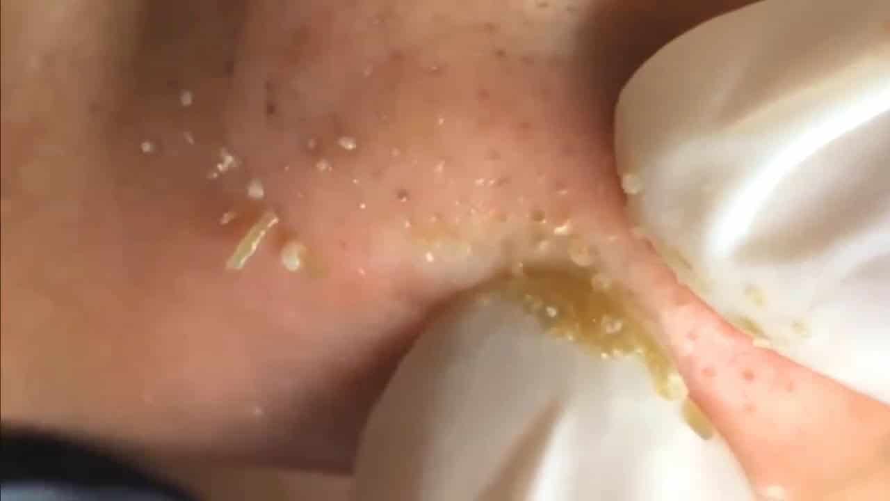 Blackheads & Milia, Big Cystic Acne Blackheads Extraction Whiteheads Removal Pimple Popping [EP2]
