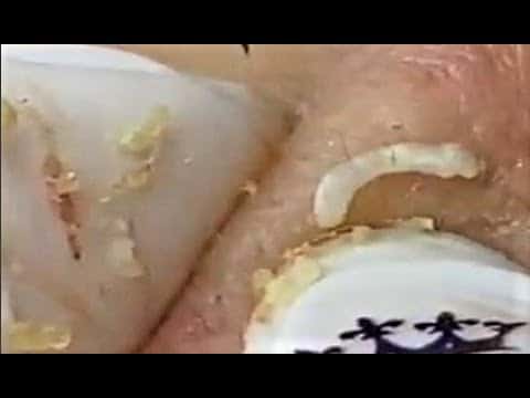 Blackheads & Milia, Big Cystic Acne Blackheads Extraction Whiteheads Removal Pimple Popping #022