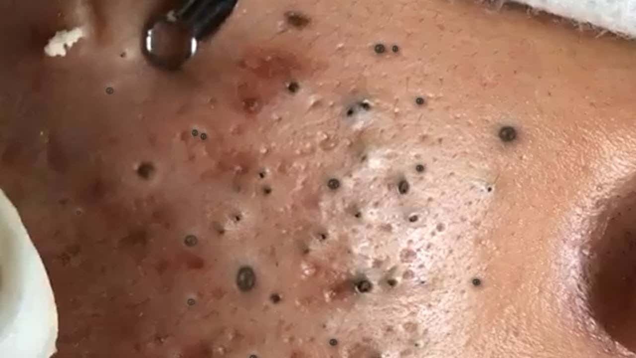 Blackheads & Milia, Big Cystic Acne Blackheads Extraction Whiteheads Removal Pimple Popping #64