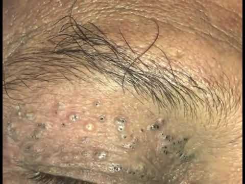 Blackheads near the eyelids – Pimple ASMR – episode 8