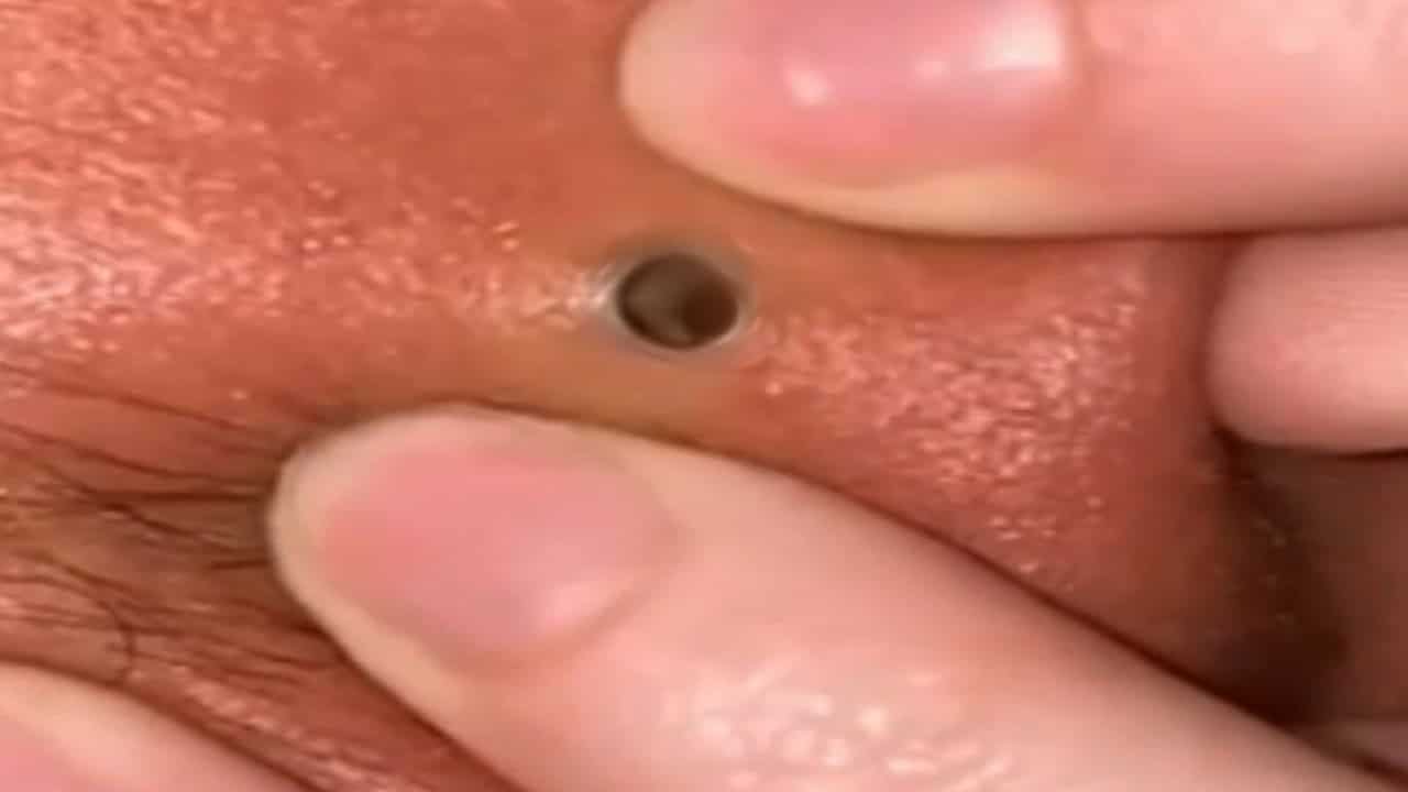 Blackheads on Face!   Largest Blackheads and Pimple Pops!